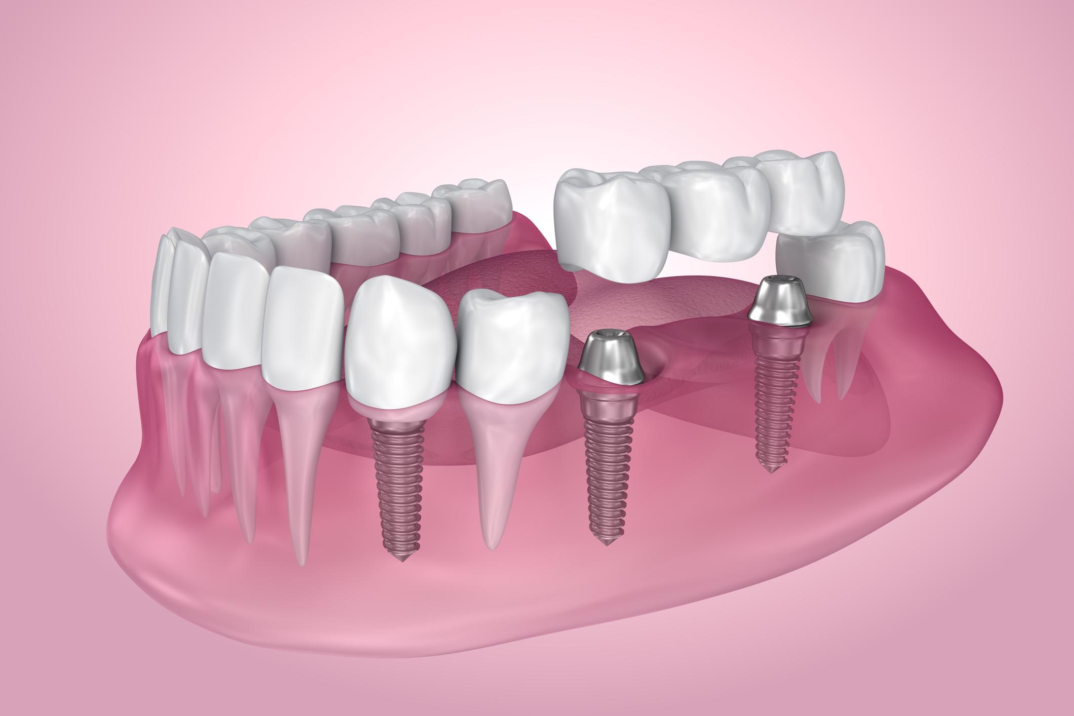 Dental Implants